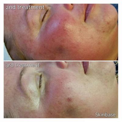 Continual Treatment Results