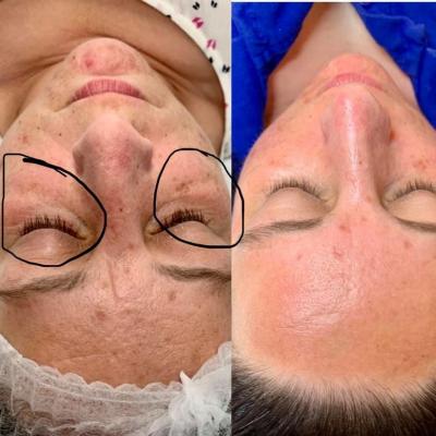 Microdermabrasion for smoother, clearer skin