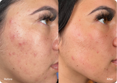 Improved acne and blemishes