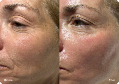 Fine lines and wrinkles reduced